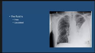 Emphysema treatment  Respiratory system diseases  NCLEXRN  Khan Academy [upl. by Marlea844]