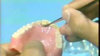 Replacing a Broken Complete Denture Tooth [upl. by Sharline134]