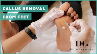 Callus removal from feet balls of feet [upl. by Ikkela]