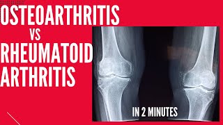 Rheumatoid Arthritis  Signs amp Symptoms  Johns Hopkins Medicine [upl. by Anifled331]