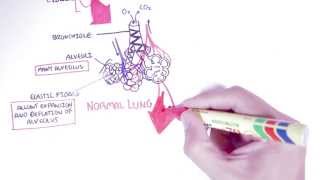 Empyema and Pleural Effusions [upl. by Waters]