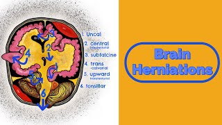 Brain Herniations and Raised ICP [upl. by Wilbert764]