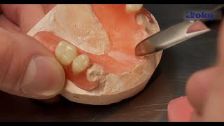 Thermoplastic dentures  Repair and service [upl. by Mensch763]