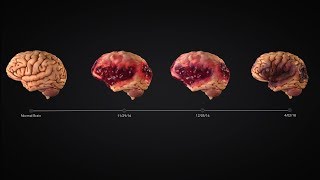 Traumatic Brain Injury Timeline Animation Charts Encephalomalacia [upl. by Ynohtnael]