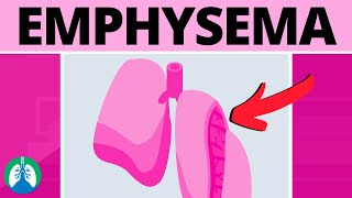 Emphysema on CT scan of Chest [upl. by Eintrok]