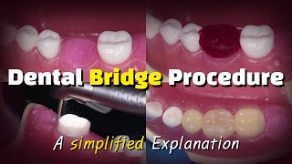 Dental Bridge Procedure [upl. by Leunammi]