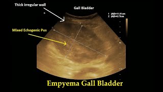 Empyema Gallbladder  Ultrasound  Case 24 [upl. by Jeannine]